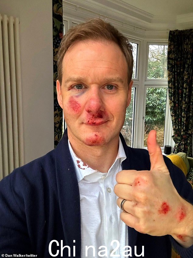 Dan Walker 在推特上发了这张自拍,这张自拍是他今天从医院回家后脸上肿胀的伤口,还有一件血迹斑斑的白衬衫