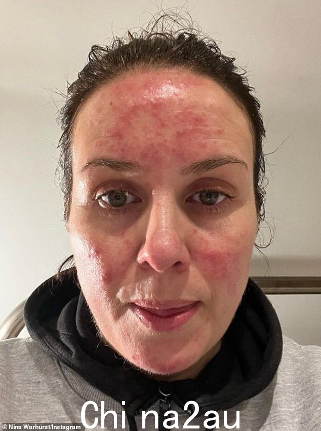 哎哟:Nina 还表现出痤疮爆发,这是她怀孕的症状之一