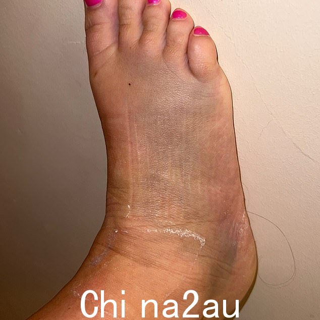 Broken: 这位电视名人周四在 Instagram 上分享了一张她瘀伤和肿胀的脚的照片,因为她透露走在上面会感觉很痛苦