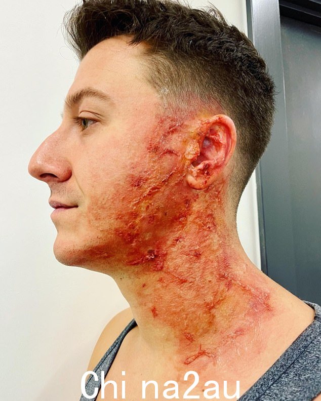 骇人听闻:加冕街酸液袭击的幕后照片揭示了 Ryan Connor 的伤势