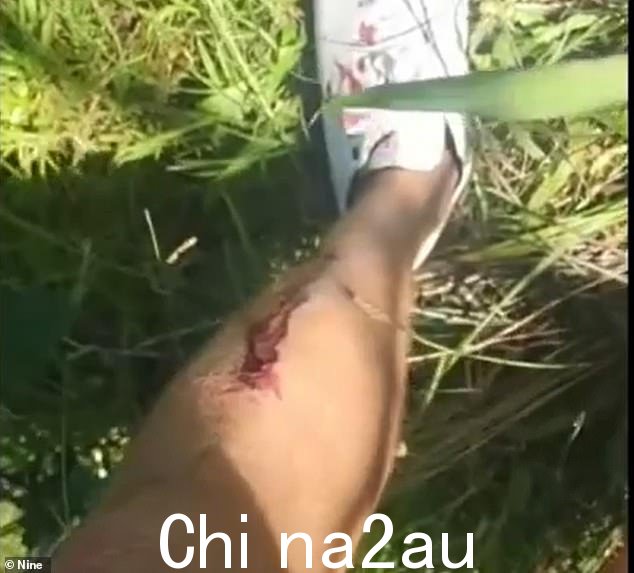 这名学习飞行员从残骸中走出来,腿断了,他迷失了方向,并在社交媒体上发布了他的经历(如图,他的腿因磨难而受伤)