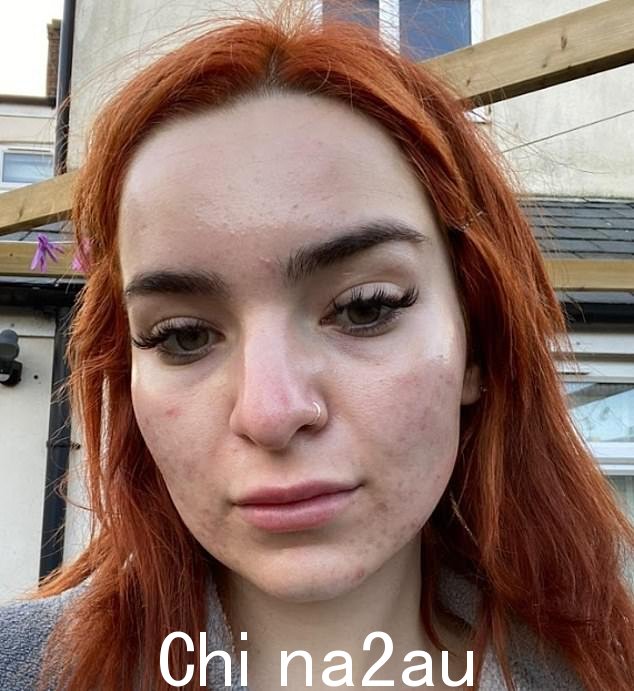 她说治疗包括抗生素、药膏、局部治疗和血清