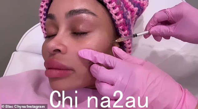 Au natural:她已经开始了一场史诗般的“治愈之旅”,去除了她所有的面部填充物(如图所示,3 月 15 日),并用激光从她的左臀部去除了一个 Baphomet 纹身”课程=