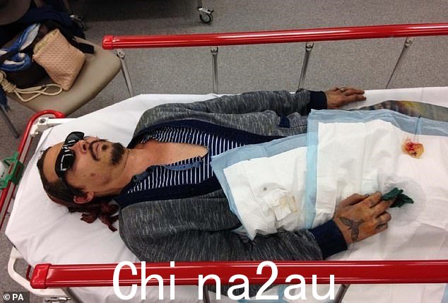 受伤:Depp 因 2015 年 3 月在澳大利亚发生的事件被送往医院,手指被切断