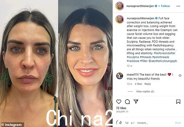 但有些人正在寻求修复 Ozempic 面部,佛罗里达州 The Aesthetics Lounge & Spa 的共同所有者詹妮弗·威尔逊 (Jennifer Wilson) 在 Instagram 上发布了一位面部丰盈度下降的客户的令人震惊的转变。'通过运动或像 Ozempic 这样的注射减肥会导致面部体积减少和下垂,这会让你看起来更老,”她说。 =