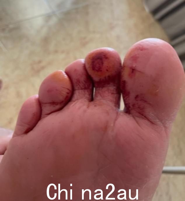 Callum 后来被医务人员告知,他脚上的血管已经“爆裂”,因为池中的氯气太浓(图中是他的一只脚)