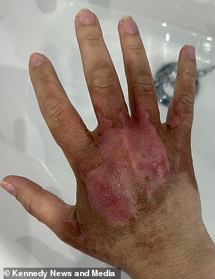 这位 29 岁的女士的烧伤最终被确定为来自入侵植物,尽管她不记得在度假时穿过树林