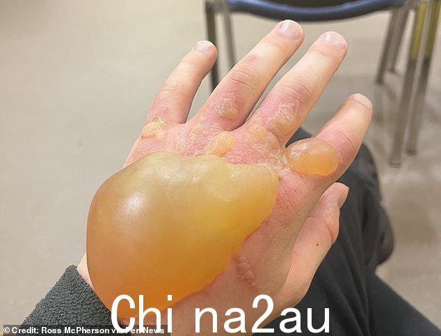 一名青少年在与巨型大猪草接触片刻后留下了一个橙子大的水泡,并努力穿衣服