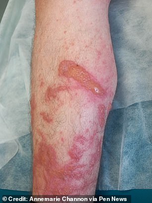 他的肉体爆发出痛苦的水泡