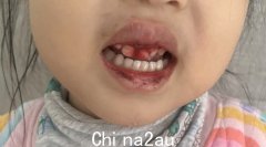 澳洲3岁亚裔女孩托儿所牙齿碎裂，父母惊愕：我们为何不知道真相（图）