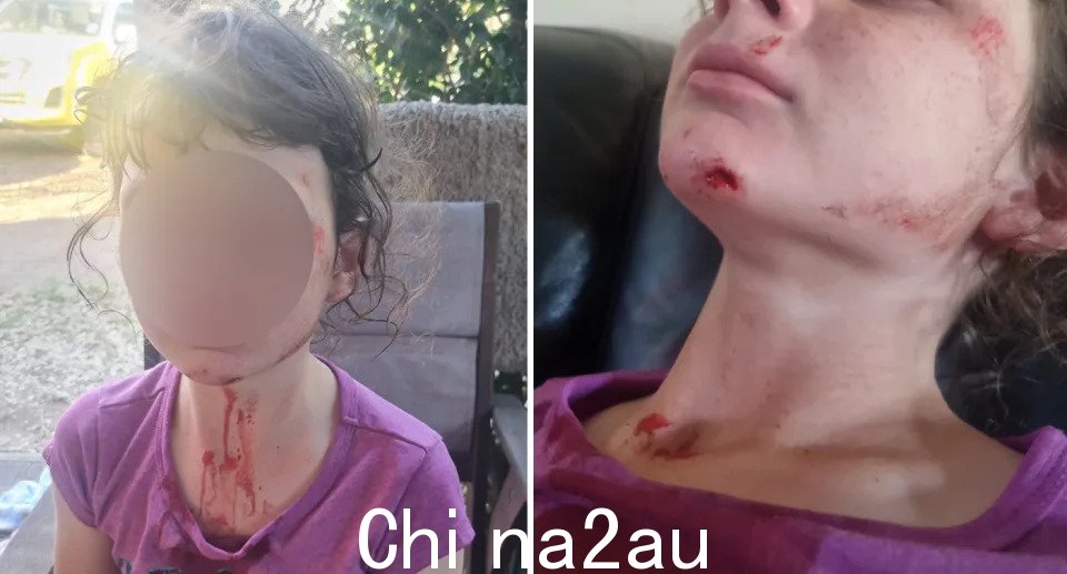 议会步道导致一名摔倒的年轻居民提供了她的踏板车，导致她的脸部有划痕和开放性伤口（右），脖子上有血（左）。