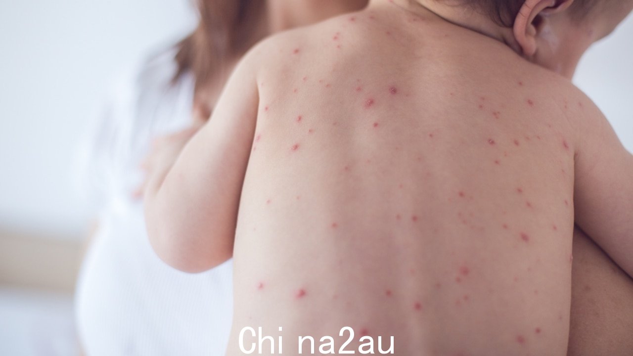 ‘值得保护每个人’：麻疹爆发的副作用‘真正令人担忧’