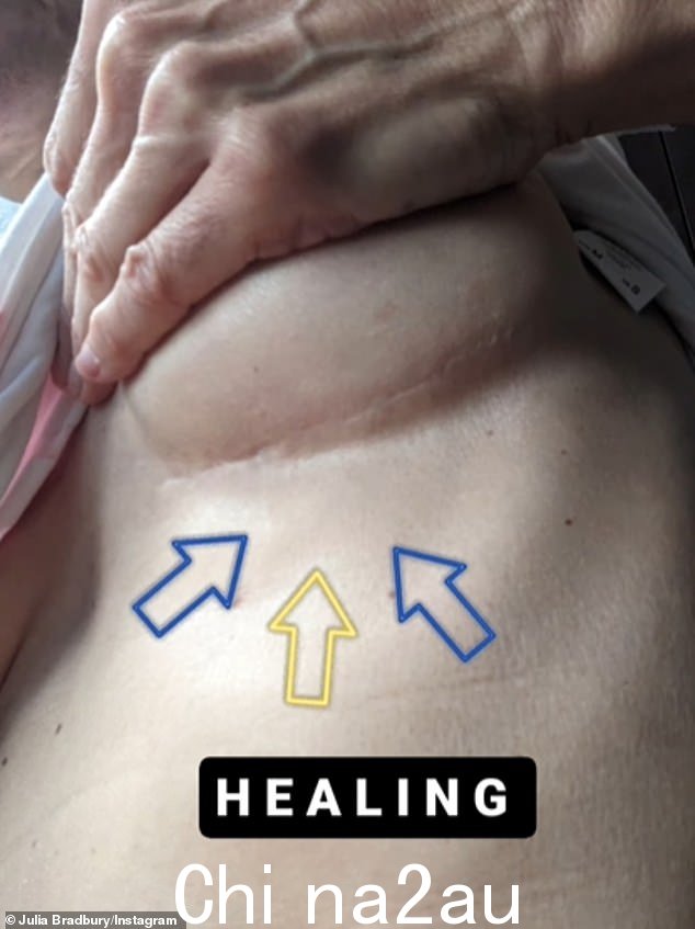 对她有好处!在此消息发布之前,朱莉娅在 2021 年诊断出乳腺癌,接受手术切除了 6 厘米肿瘤后,勇敢地揭露了她的乳房切除术疤痕