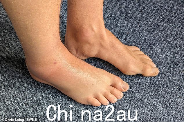 莱恩先生感到右脚踝剧烈刺痛(如图所示,肿胀)。当他低头一看时,他震惊地发现一条蝰蛇正咬着他