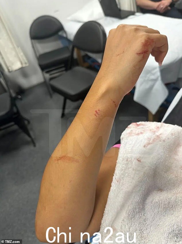 瘀伤:被麦克风击中的女士手臂上也有瘀伤和其他较小的擦伤