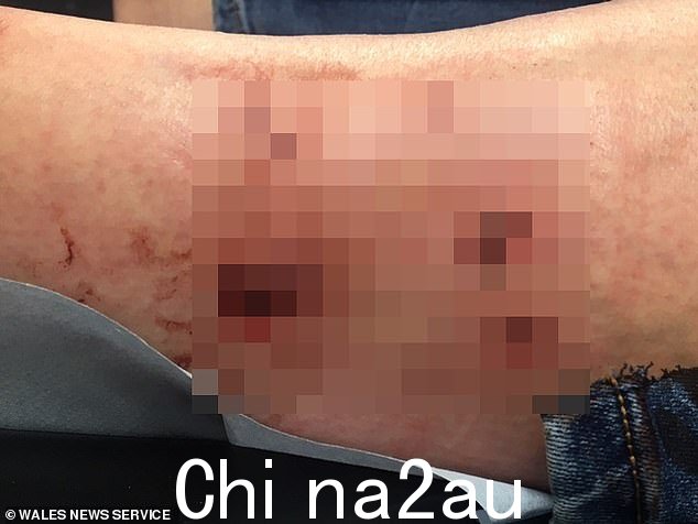 米勒德女士说,当她看到两只狗靠近时,她感到“不知所措”,每当她进入公园时,她都会“寻找出口”。图为:Millard 女士腿部受伤