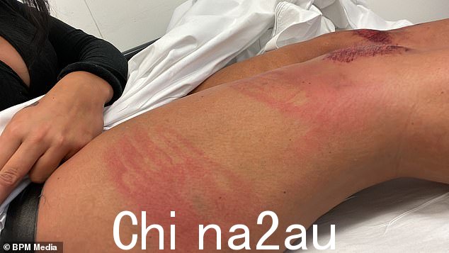 今年3月4日发生的袭击事件中麦克唐纳在贝克利女士身上留下的手印