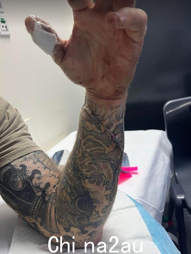 Elliott 在等救护车时被家里婴儿的摇椅绊倒,差点失血过多身亡