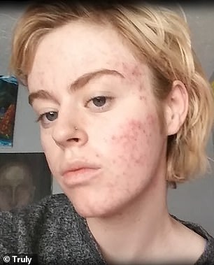 悉尼 15 岁时出现严重的囊性痤疮后,她的医生发现她的雄激素水平升高。她接受了激素治疗,以使其变得‘正常’