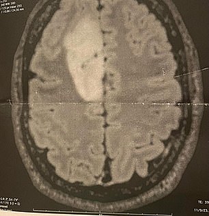 扫描:根据梅奥诊所的说法,神经胶质瘤是“从大脑或脊髓开始的细胞生长”