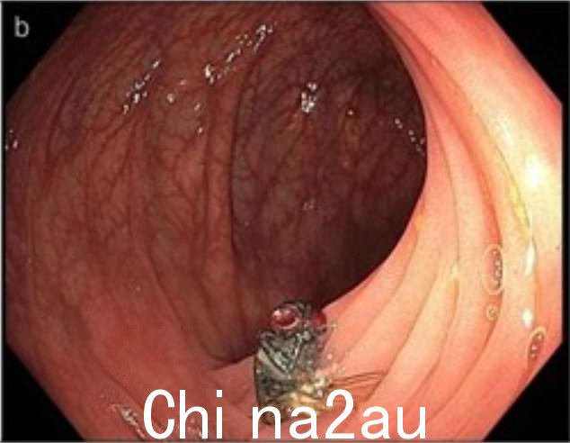 密苏里州的医生称这一发现是一个“谜”。昆虫幼虫有可能感染肠道,正如之前的案例所示