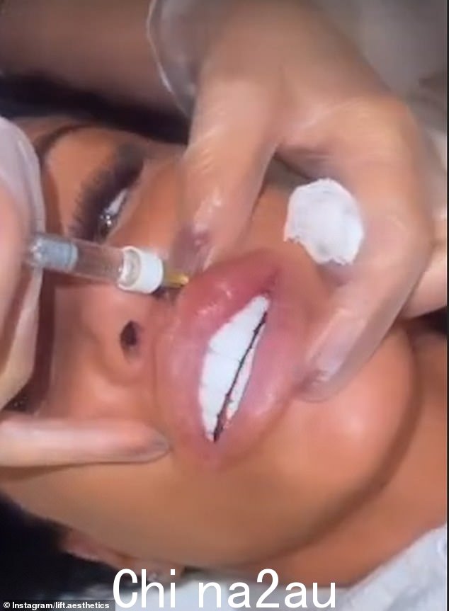 可怕:凯蒂分享了一段用填充剂填充嘴唇的片段