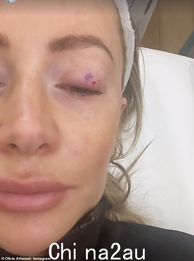奥利维亚·阿特伍德 (Olivia Attwood) 周五在 Instagram 上发布动态,因医疗紧急情况迫使她错过了 Loose Women 圣诞派对