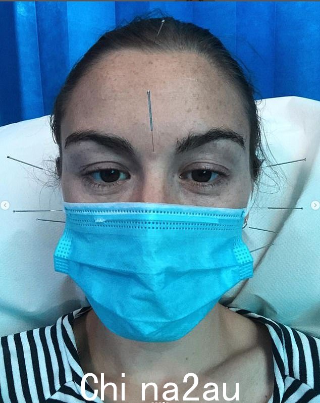Boxer 女士还在社交媒体上分享了自己接受针灸治疗的照片
