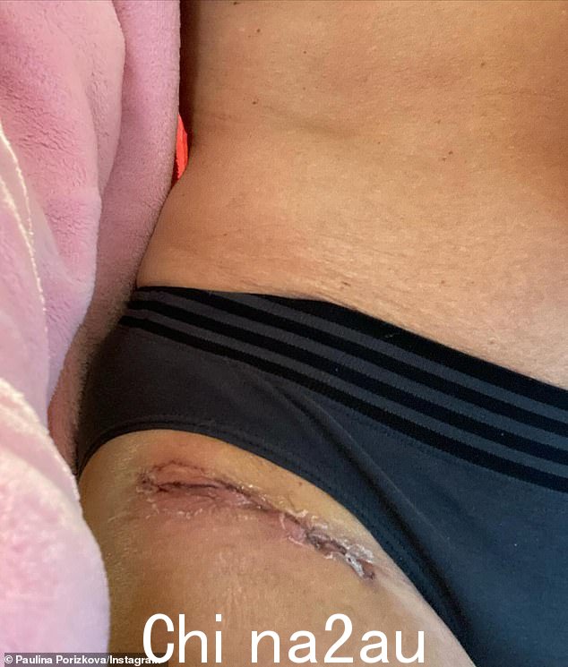 她还附上了两张正在愈合的伤口的特写照片