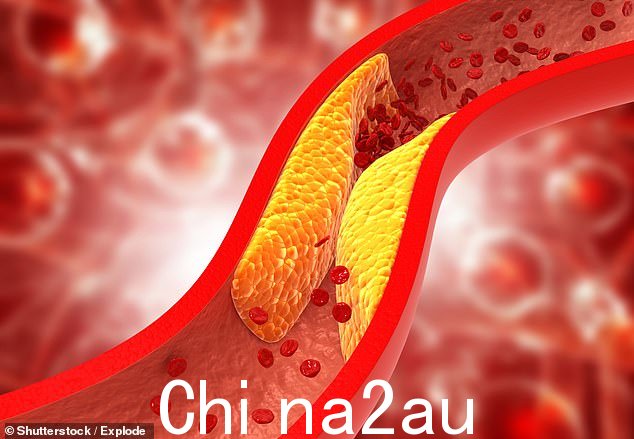 胆固醇有两种主要类型:“坏”LDL(低密度脂蛋白),它会滞留在血管壁中,形成脂肪沉积物,从而阻碍血液流动