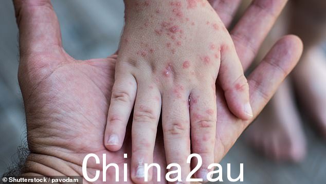 麻疹会引起皮疹和发烧,并可能引发严重的健康并发症。它具有高度传染性,可能致命(库存图片)