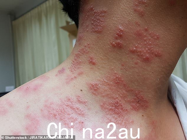 虽然如果在很小的时候患上水痘,通常不会很严重,但这种病毒可能会在以后的生活中以带状疱疹的形式重新激活,并表现为起水泡的斑点状红色皮疹