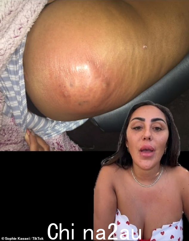 她在周一在 TikTok 上发布的一段坦率视频中公开了自己的“创伤性”手术,“几乎要了她的命”