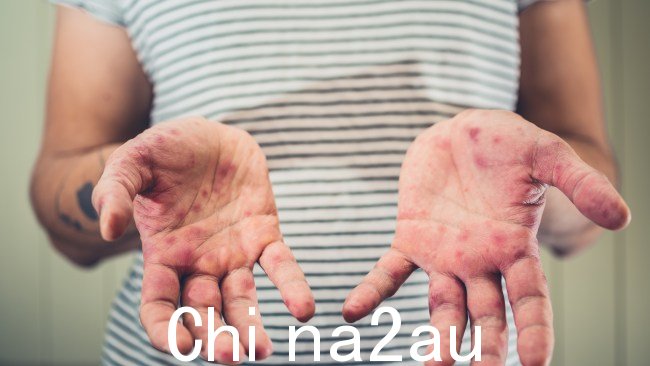 红色、斑点状皮疹麻疹引起的,可以扩散到全身。图片:iStock