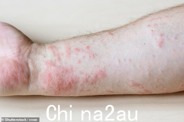 光接触性皮炎可由多种食物引发,包括无花果、芹菜甚至胡萝卜