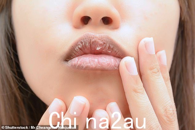 嘴唇干裂可能会伴随着嘴唇和口腔周围的刺痛或烧灼感,这会导致嘴唇干裂。我们中的许多人可能只与寒冷的天气联系在一起