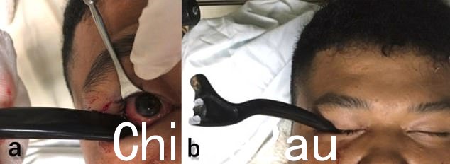 令人反胃的图像显示把手嵌在身份不明的 19 岁男子的右眼窝中。据信消防员必须在事故现场从自行车上切下刹车杆
