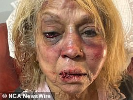 Ninette Simons(如图)据称遭到袭击,这群人将她按在地上,并对她的脸部拳打数次,将她打昏