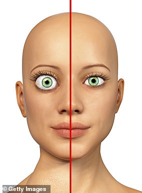 一幅 3D 插图,显示一名患有格雷夫斯病的妇女,该病使眼睛凸出