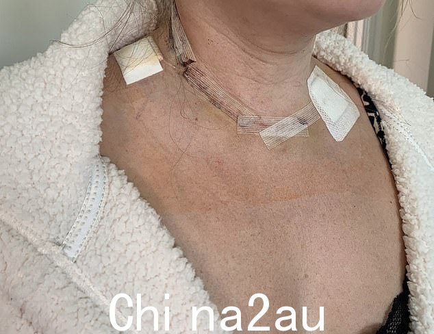 扫描六周后,Abi 接受了手术,切除了甲状腺和颈部右侧的所有淋巴结