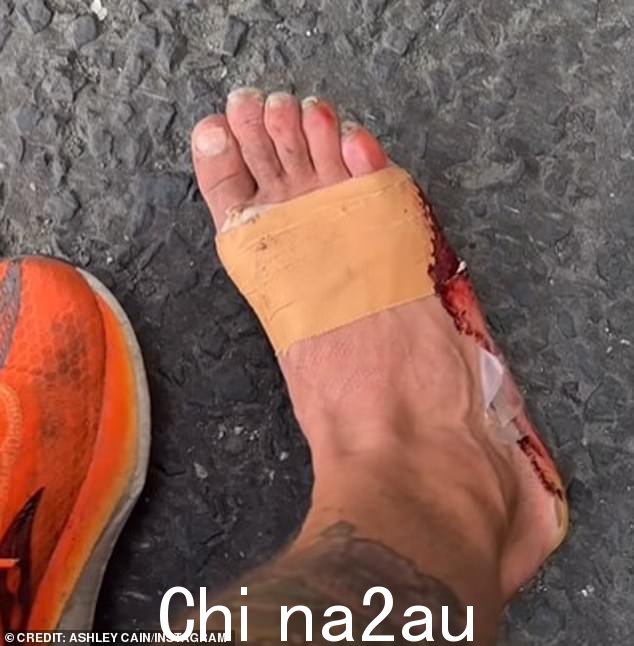 到目前为止,这位前真人秀明星已经跑了 1,307 英里,根据他的 Instagram 帖子,其中有一段视频显示该隐的脚血迹斑斑,缠着绷带,其中一个脚趾甲脱落了