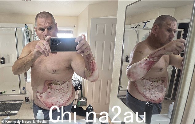在进行皮肤移植后(如上图所示),这位父亲现已出院,正在家中与家人一起康复