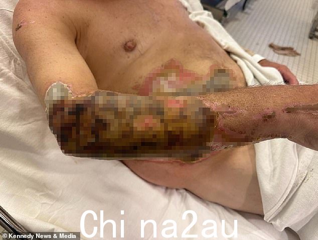 他说他的烧伤已经开始愈合,但是烹饪事故将使他终生伤痕累累