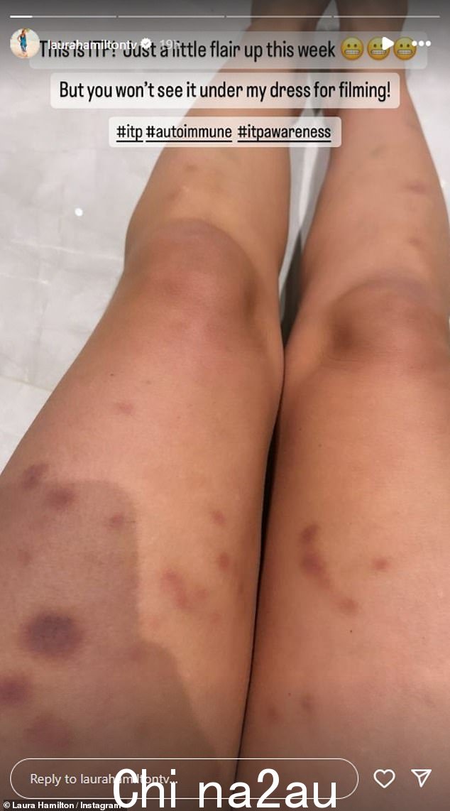 电视主持人患有免疫性血小板减少性紫癜 (ITP),这是一种导致血小板水平低下的疾病,常常使她出现过度瘀伤