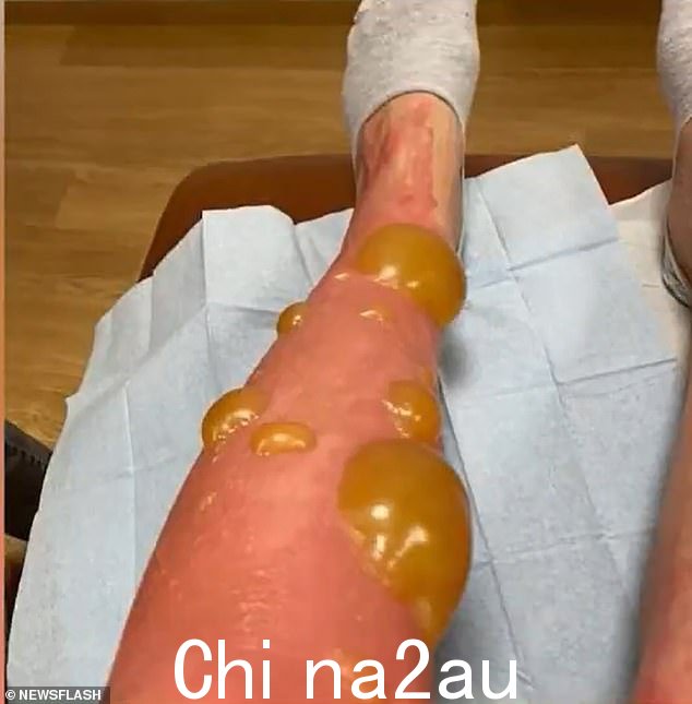 然而,第二天早上,母女俩醒来发现手臂和腿上长满了红色和黄色的水泡。有关实际病情的详细信息很少