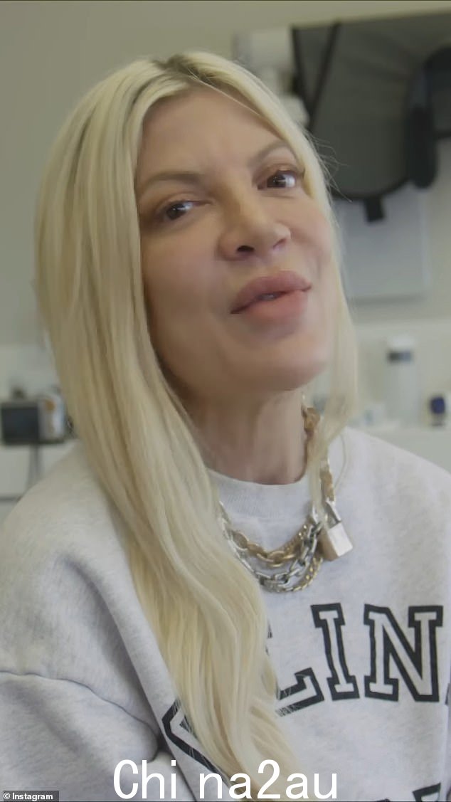 Tori Spelling 让粉丝们深入了解了贴面手术,这提高了她的信心水平,让她“再次微笑”