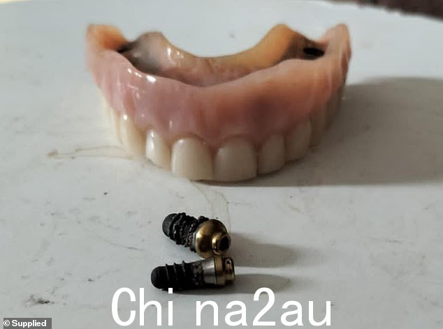 格林女士的整个顶排牙齿在袭击后必须被移除,她接受了种植体,但将它们固定在她下巴上的螺钉(如图)在一年后就丢失了