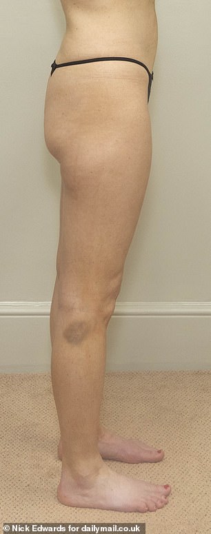 Samantha Rea 接受 EmSculpt Neo 臀部提升治疗前