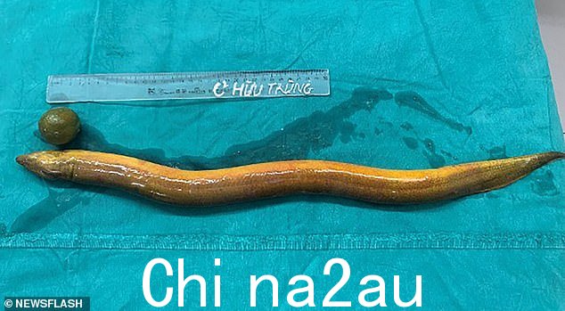 这张 26 英寸生物在手术台上的照片 - 旁边还有一个据报道也从该男子肛门中取出的柠檬