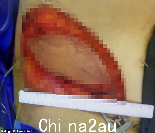他们从她的腹股沟区域取走了肉和皮肤